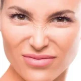 Toxina botulinica para Bunny Lines