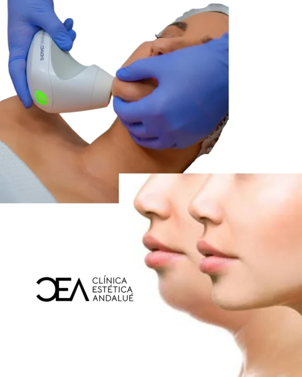 3 Lipopada Enzimática + 6 sesiones Radio frecuencia + 6 sesiones Drenaje linfático manual.