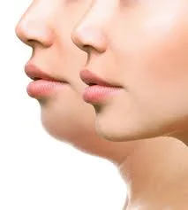 Lipopapada Enzimática