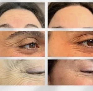 Toxina Botulínica + Limpieza Aquapure2 + Mesoterapia Vitaminas/ regalo lifting de pestañas